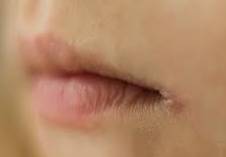 楊浩康(Yeung Ho Hong)醫生講解甚麼是口角炎 (Angular Stomatitis) ?--Yeung Ho Hong, 楊浩康