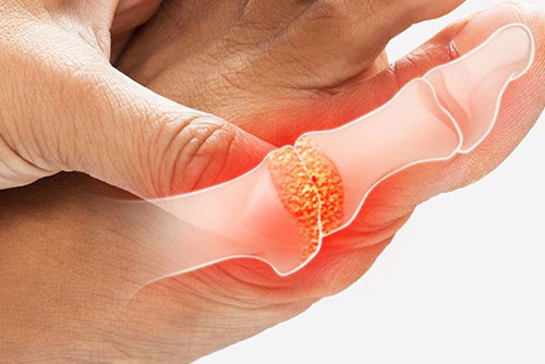 楊浩康(Yeung Ho Hong)醫生講解甚麼是痛風 Gout？