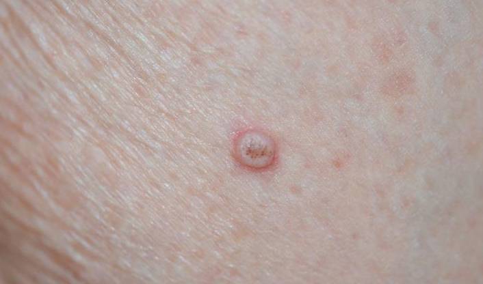 楊浩康(Yeung Ho Hong)醫生講解甚麼是角化棘皮瘤 (Keratoacanthoma)？--Yeung Ho Hong, 楊浩康