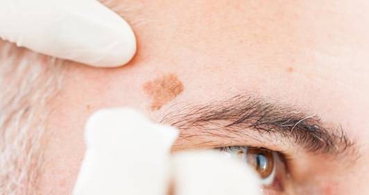 楊浩康(Yeung Ho Hong)醫生講解日光性角化症 (Solar keratosis) 的治療--Yeung Ho Hong, 楊浩康